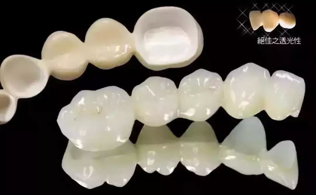 烤瓷牙对比全瓷牙有什么优点,烤瓷牙和全瓷牙哪个性价比更高