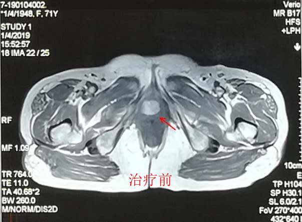 中医肿瘤专家谈黑色素肿瘤治疗,重离子肿瘤治疗