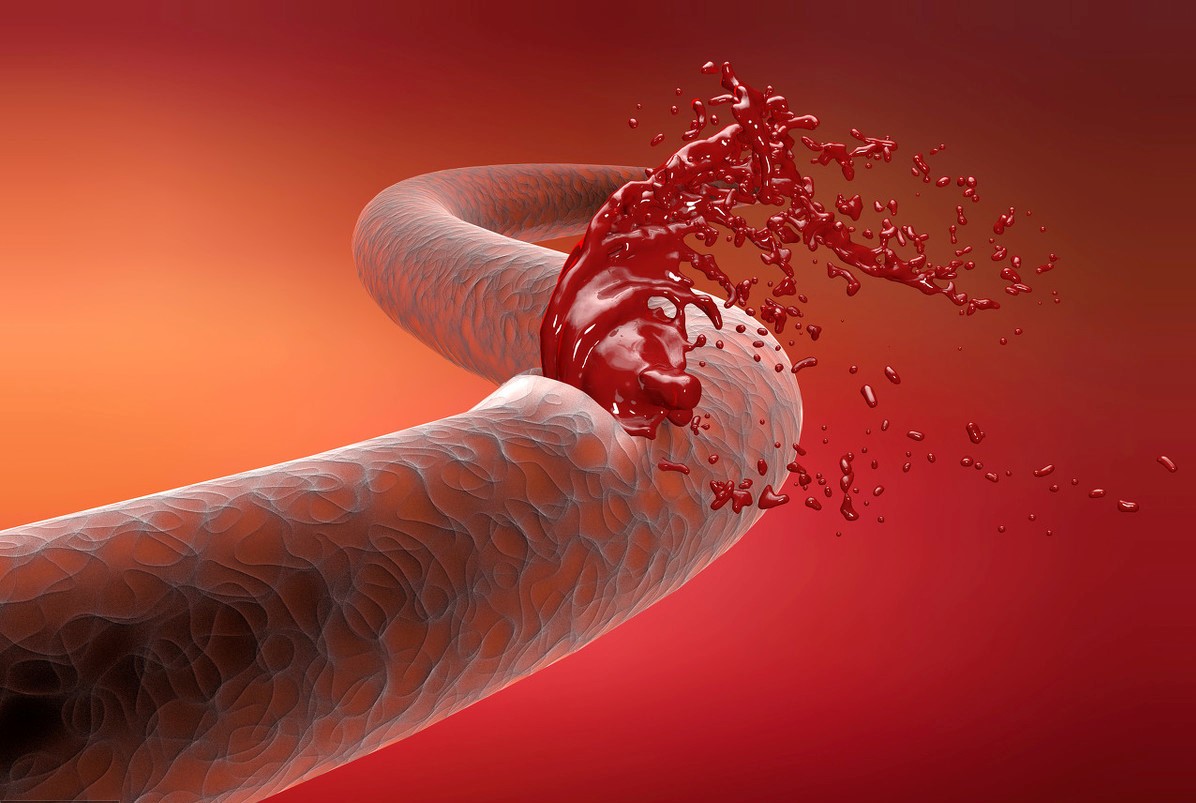 害怕脑出血,阿司匹林导致脑出血可以救回来吗