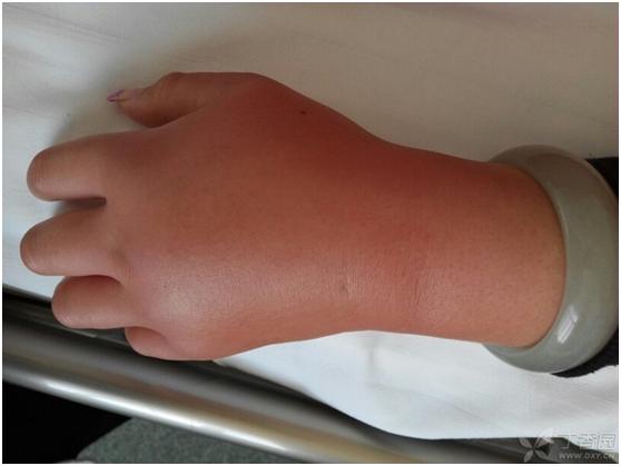 23岁女孩得了银屑病怎么办,学生得银屑病怎么办