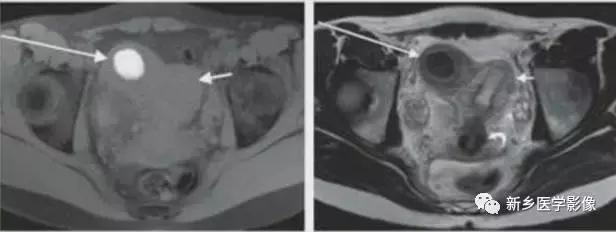 子宫发育异常，应想到的6大类常见畸形