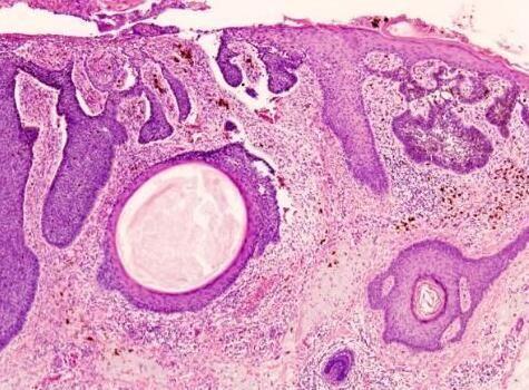 医生黑痣,医生长在摩擦部位的黑痣要当心