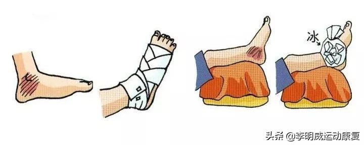 轻度脚踝扭伤的处理方法及康复,脚踝扭伤康复训练6种简单方法