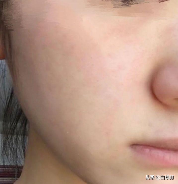 红肿痘痘不疼了但是还是有包,红肿痘痘摸着软软的一直不冒白头