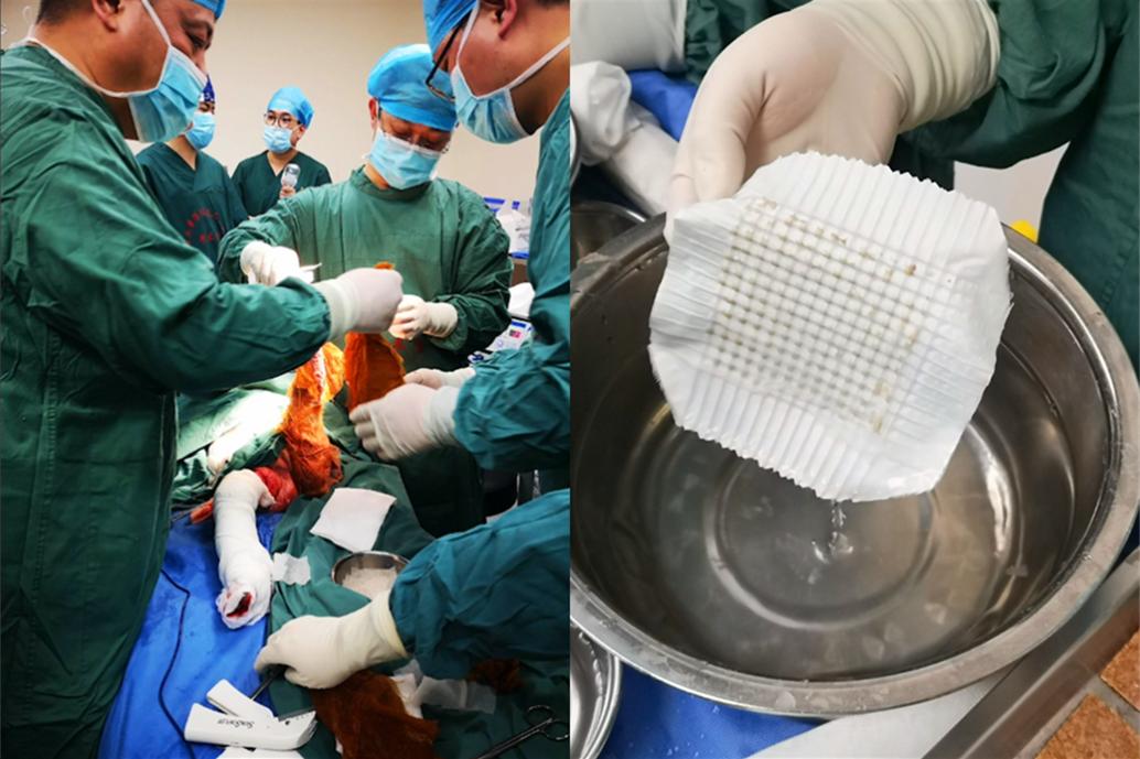 小女孩儿烧伤植皮,烧伤女婴被遗弃后续