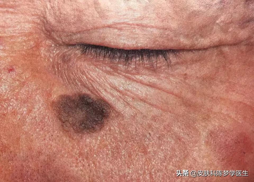 如何治疗脸上褐青色痣样斑,什么是褐青痣斑