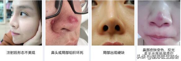 玻尿酸隆鼻副作用图片,玻尿酸隆鼻好不好优势有哪些