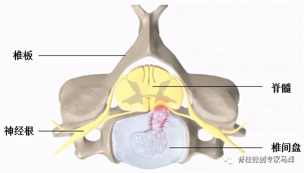 脊椎狭窄压迫神经腿疼怎么治疗,神经根痛上肢麻木怎么康复