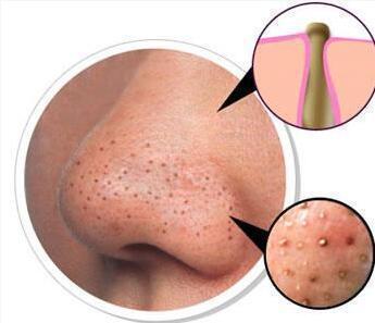 鼻子挤出白粒是螨虫吗,毛孔里挤出来黄色小颗粒是螨虫吗