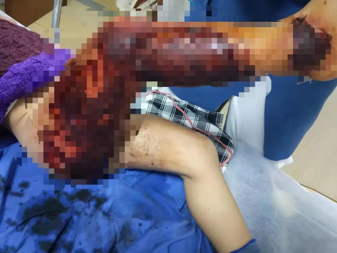 心疼小孩被烫伤,孩子烫伤用民间医生偏方