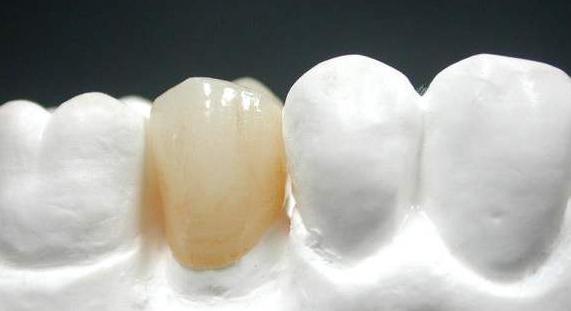 全瓷牙和烤瓷牙的区别到底在哪,全瓷牙与普通烤瓷牙的区别是什么