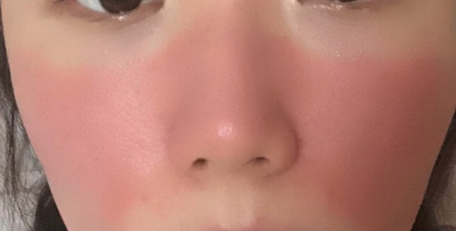 哪种医美项目祛痘印最有效,最有效的医美抗衰项目