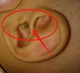 4岁男童突然耳朵疼,4岁孩子说耳朵疼然后夜晚发烧