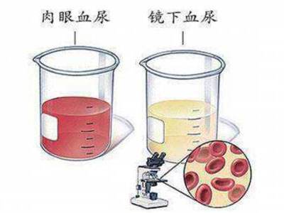 体检发现尿潜血怎么办？别担心，三步帮你解决问题！