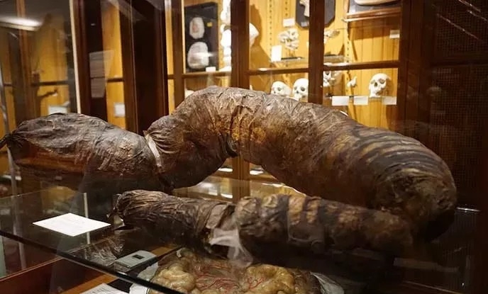 便秘能致人死亡吗,人会因为便秘而死吗