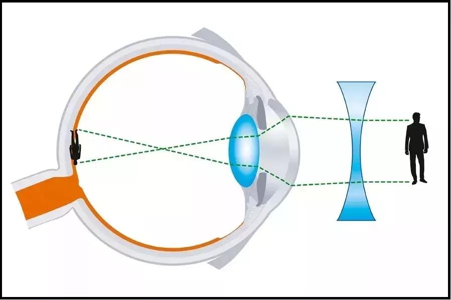 为什么高度近视不建议激烈运动呢,高度近视做完手术可以剧烈运动吗
