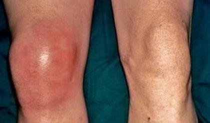 膝盖有滑膜炎要紧吗,膝盖有滑膜炎怎么治疗