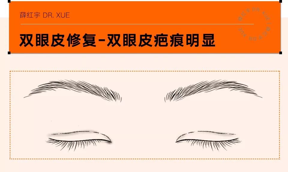 双眼皮整形修复,潘贰双眼皮修复