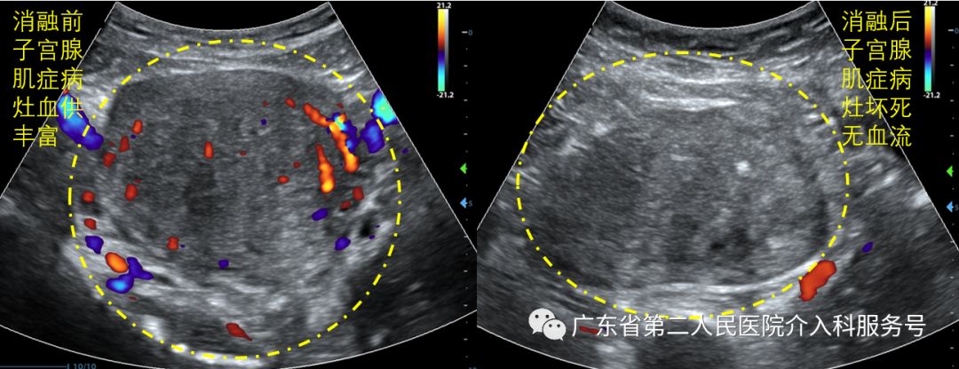 痛经消融手术,痛经微创