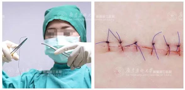 甲状腺手术后疤痕增生期是多久,甲状腺结节手术后疤痕怎样消除