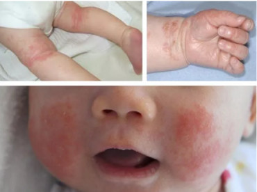 手湿疹反复发作如何除根,男孩湿疹反复发作怎么治