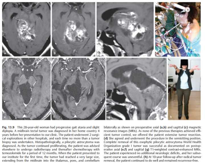 胶质瘤四级从开始就是四级吗,胶质瘤二级会不会升三级