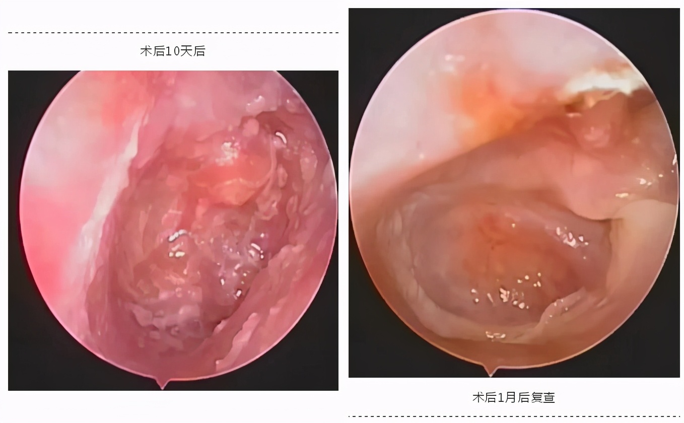 耳朵有脓要挤出来吗,耳朵有脓怎么往出来吸