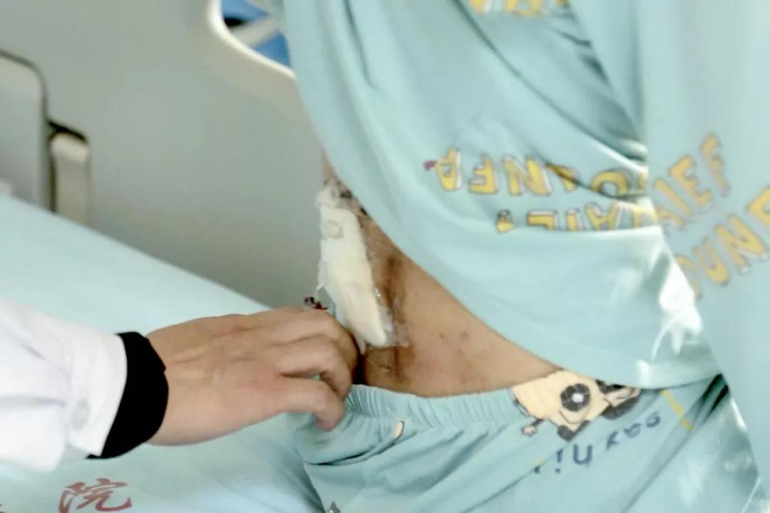 撸串引起的病症,撸串引发的事