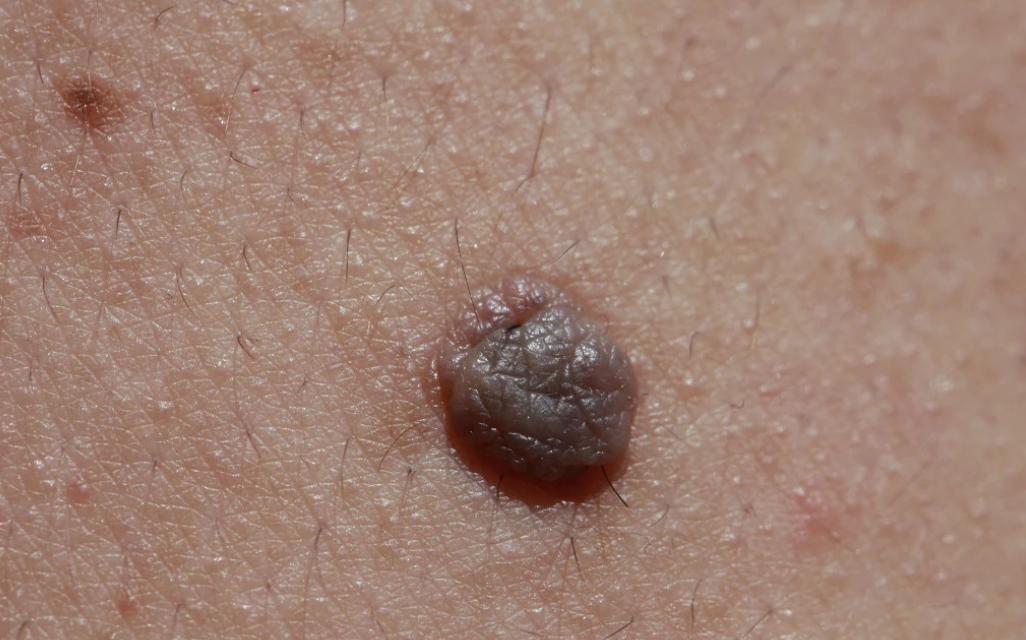 为什么身上会长“肉疙瘩”？是脂肪瘤吗？医生教你如何判断