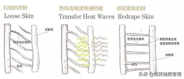 除了热玛吉还有什么抗衰仪器,抗衰美容仪器热玛吉