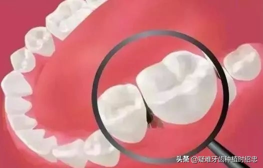 牙缝大是福是祸,牙缝宽什么命运