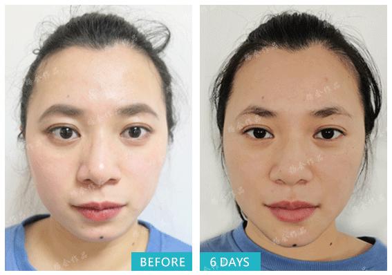 隆下巴硅胶和膨体哪个好,膨体隆下巴和硅胶隆下巴区别