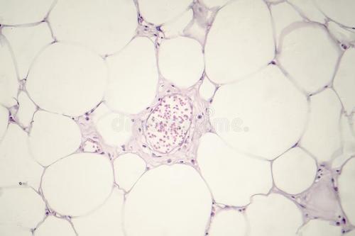 皮下脂肪瘤突然增大又会变小,长了脂肪瘤怎么办