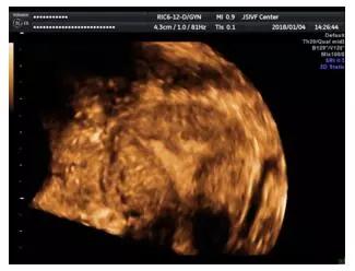 三维超声对宫腔粘连评估的重要性