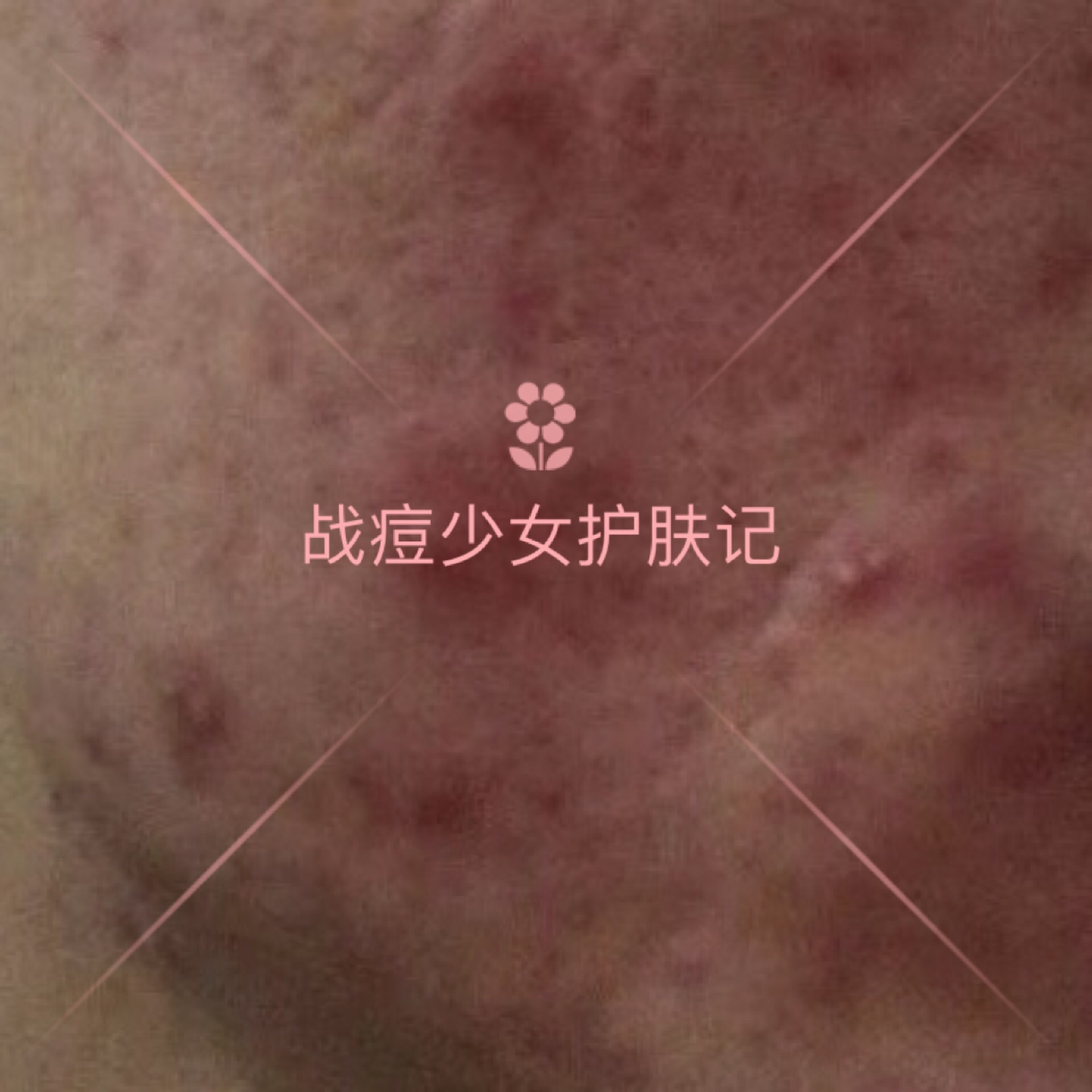 6种痘痘对号入座，1分钟教会你认清痘痘类型，对症战痘！