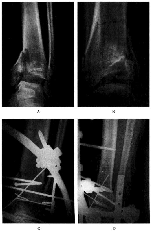 骨折外固定实践技能,科普骨折内固定取出