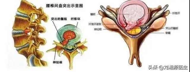 免疫相关不良妊娠答疑解惑,怀孕如何避免强直性脊柱炎
