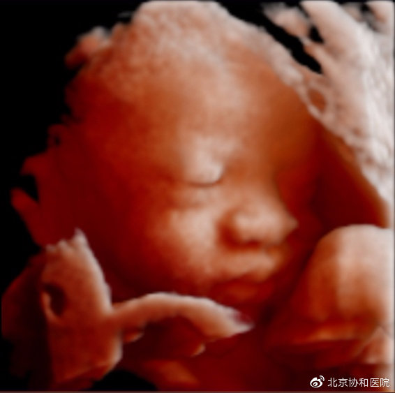 四维彩超和二维超声检查有啥区别,四维彩超和产前诊断超声