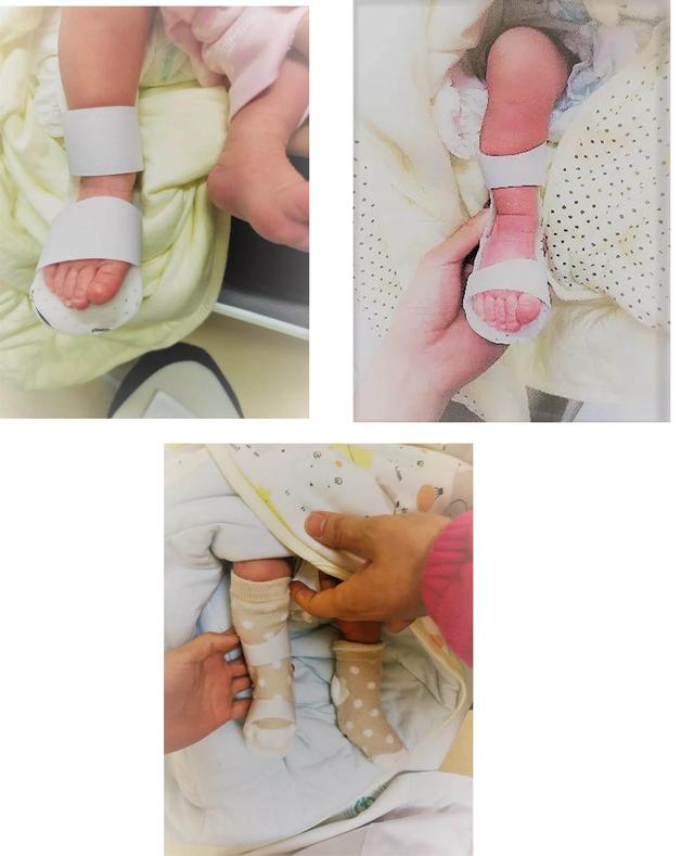 足内翻导致的小腿外翻怎么办,足内翻是怎么样