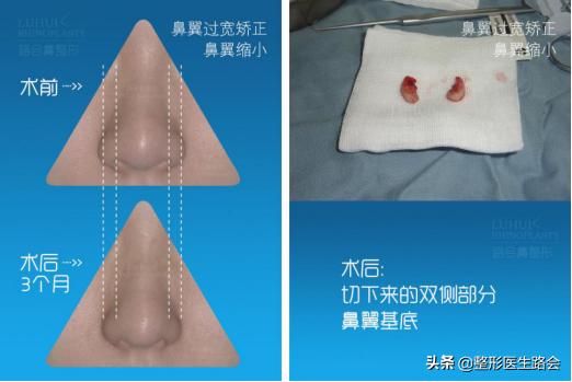 鼻翼缩小和鼻翼缩小之后的对比,超有效的缩小鼻翼的方法