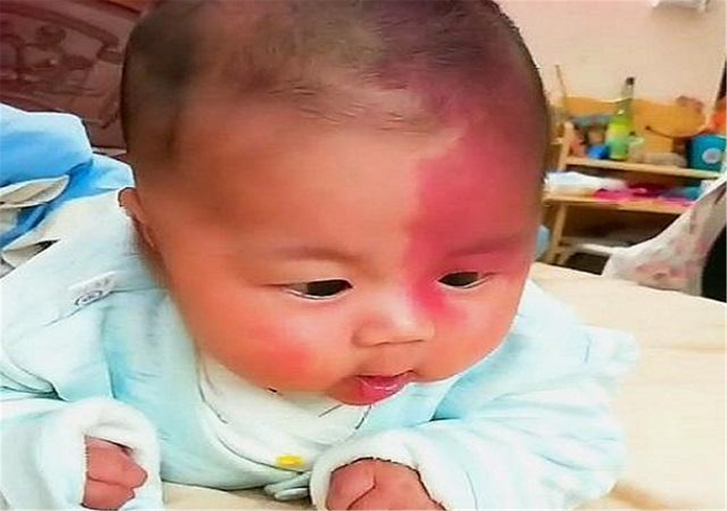 胎儿长胎记是怎么造成的,胎儿容易长胎记的原因是什么