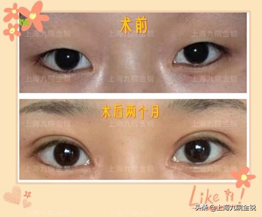 双眼皮VS单眼皮，为什么更多人喜欢双眼皮？