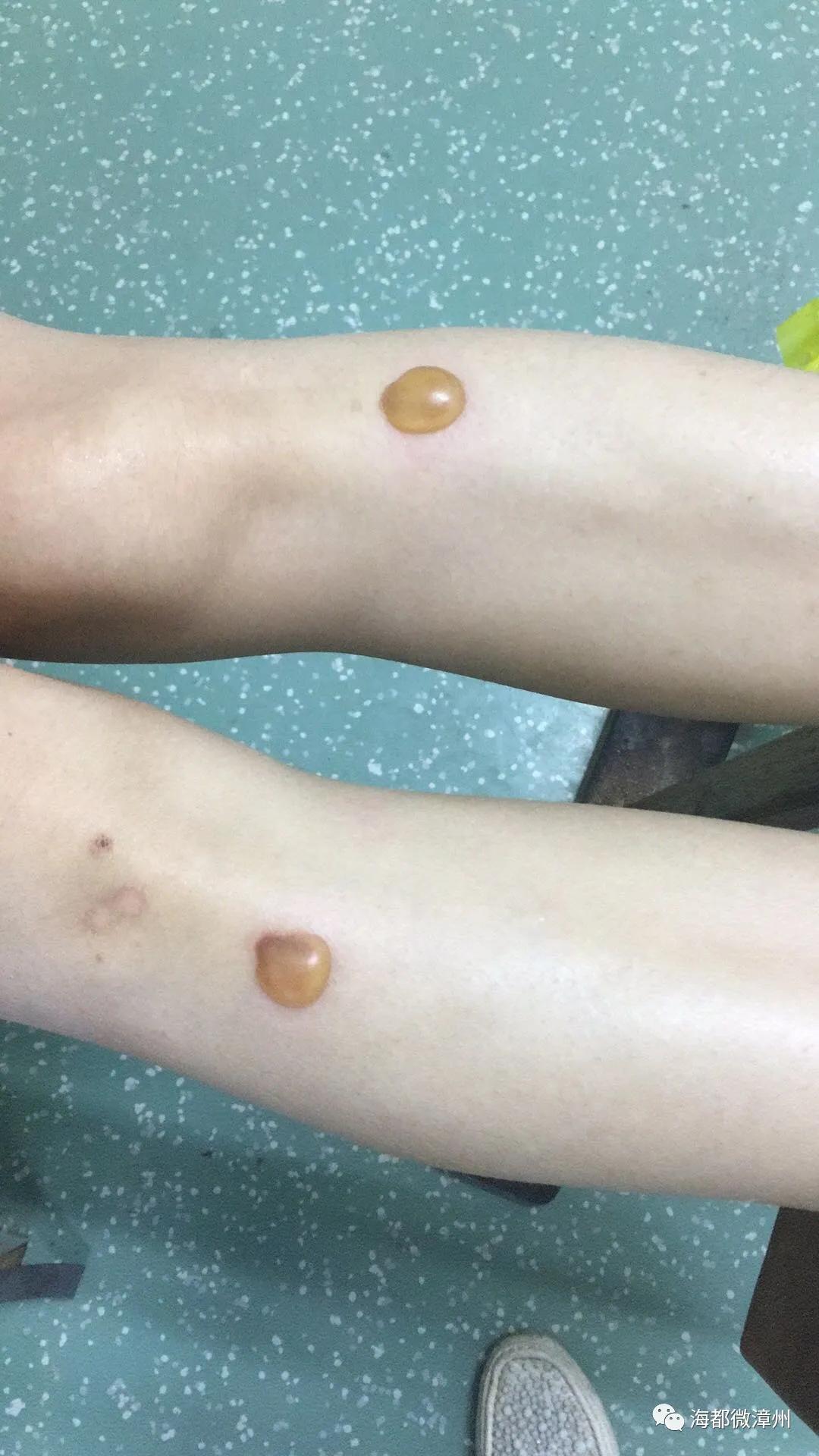 患者艾灸烫伤原因分析及整改措施,艾灸烫伤算意外吗