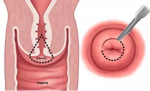 别只盯着HPV疫苗！年过25岁，却还不了解宫颈癌筛查？