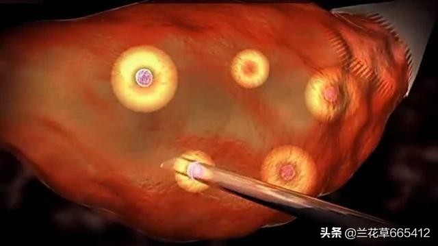 试管婴儿视频全过程应多少天完成,做试管婴儿很痛吗