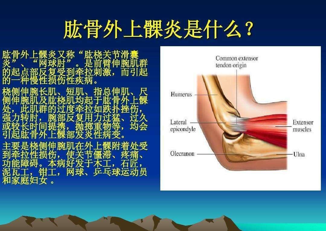 网球肘肌肉劳损,网球肘造成胳膊弯了最佳治疗方法