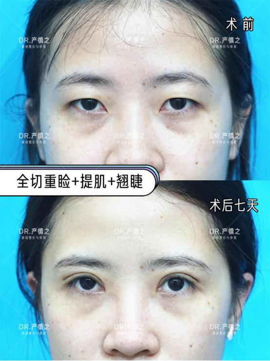 没有内眦赘皮可以开内眼角么,有内眦赘皮不开眼角只割双眼皮