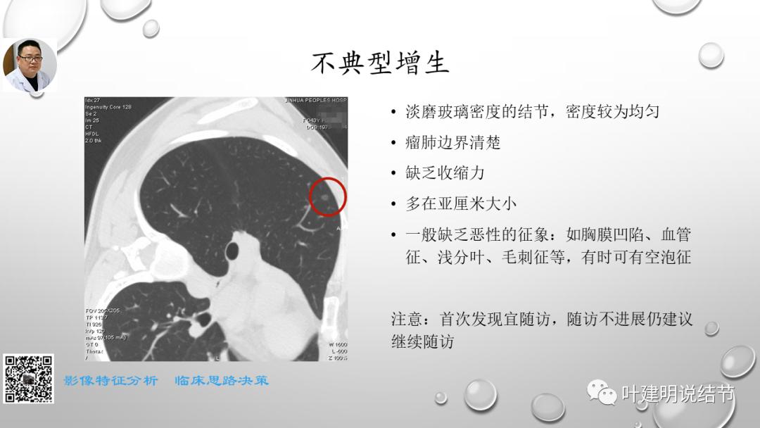 叶建明谈肺实性小结节视频,廖正银教授谈肺结节