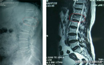 专家建议：老年人出现腰椎骨折，不一定需要做手术！