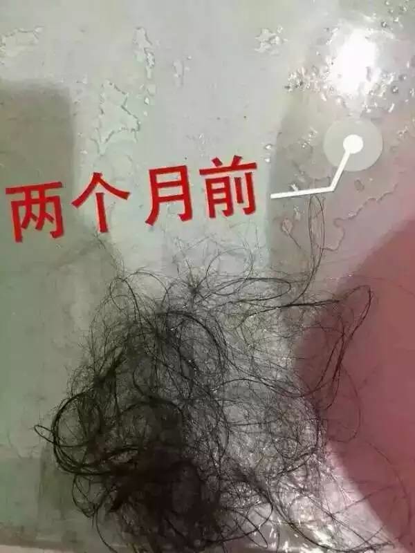 头皮痒头皮屑多脱发严重怎么回事,头皮屑结痂成大块伴有瘙痒脱发